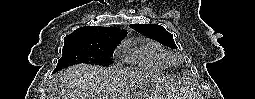 Coronal CT