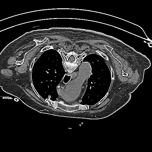 Axial CT