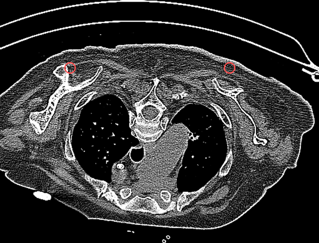 CT lesion